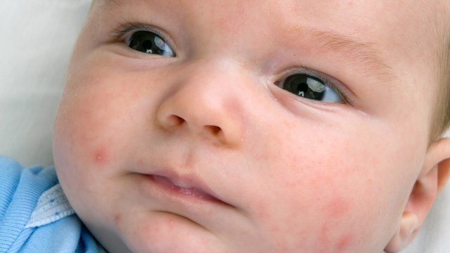 What Causes Baby Acne