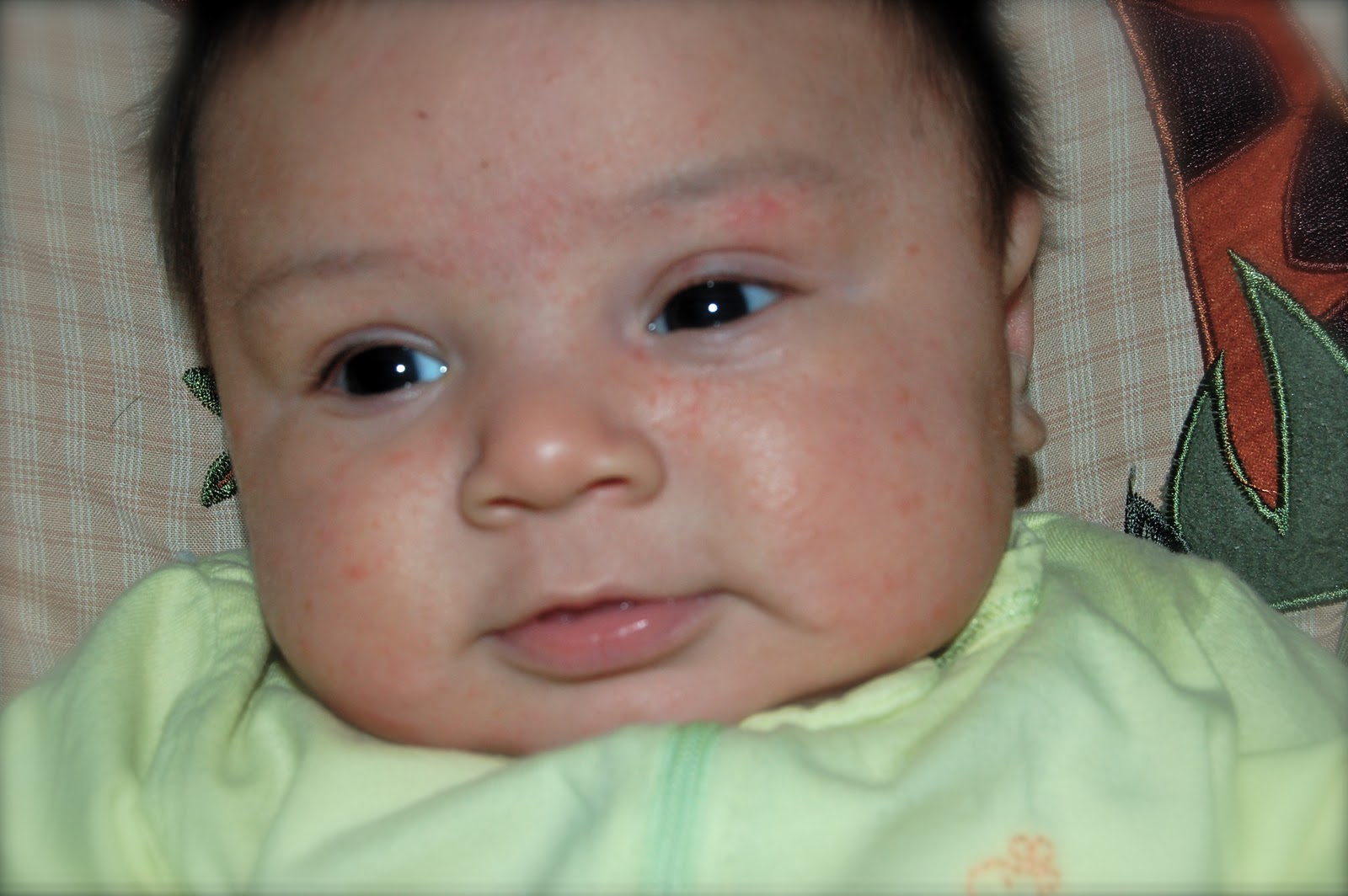 What Is Baby Acne Why Your Baby Has Acne?